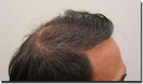 Hair restoration procedure results