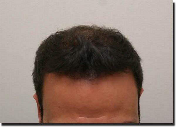 Hair restoration procedure results