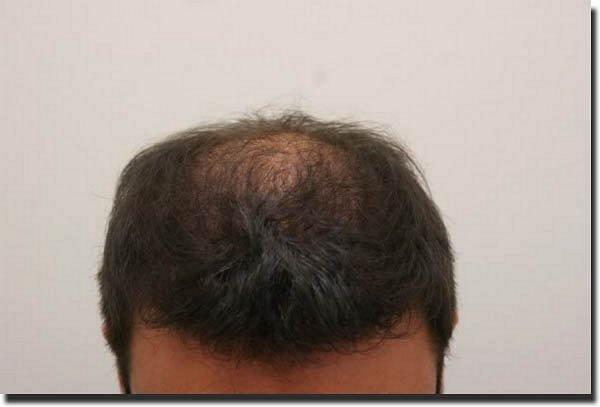 Hair restoration procedure results