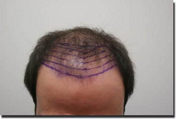 Hair restoration procedure results