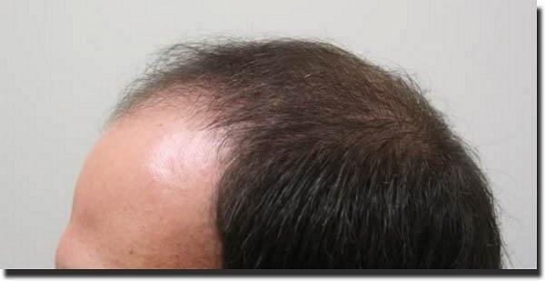 Hair restoration procedure results