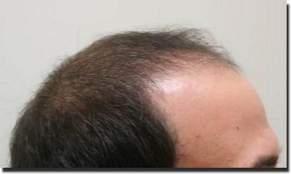 Hair restoration procedure results