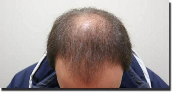 Hair restoration procedure results