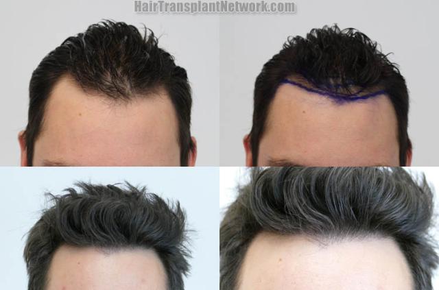 Hair transplantation surgery before and after images