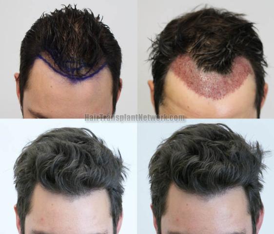 Top view before and after hair restoration results