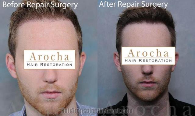 Hair restoration procedure before and after results