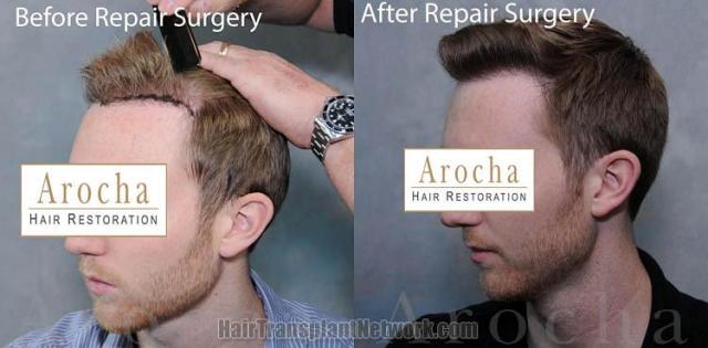 Hair transplantation surgery before and after images