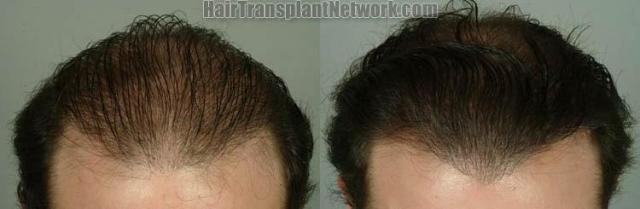 Hair transplantation surgery before and after images