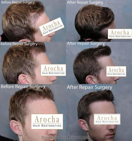 Hair transplantation surgery before and after photos