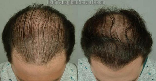 Top view before and after hair restoration results