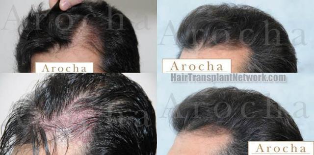 Left view - Before and after hair transplantation photos