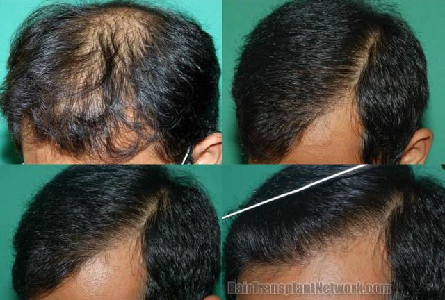 Hair restoration procedure before and after results