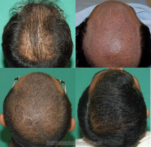 Before and after hair transplant procedure images