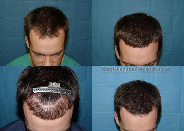 Top view - Before and after hair transplantation images