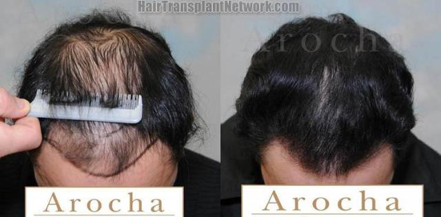 Before and after hair restoration procedure images