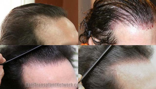 Before and after hair transplant procedure images