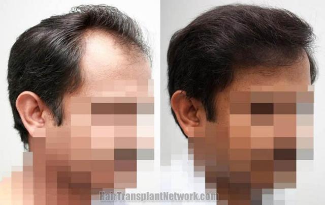 Hair transplantation surgery before and after pictures