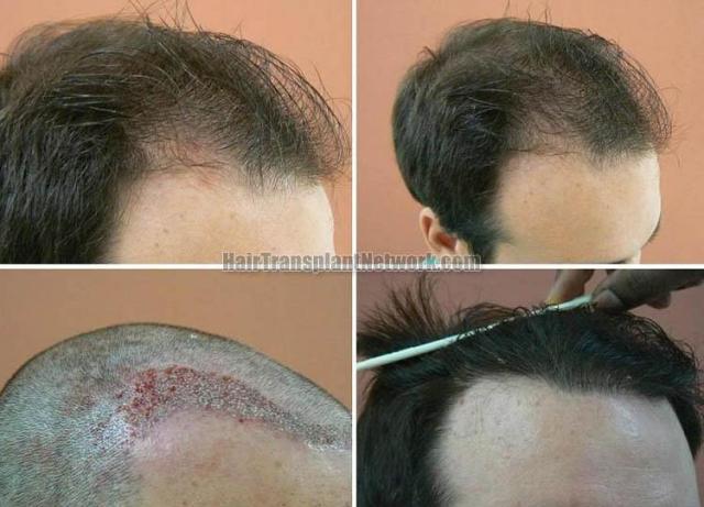 Hair transplantation surgery before and after images