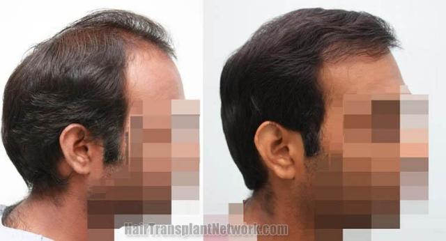 Hair transplantation surgery before and after photos