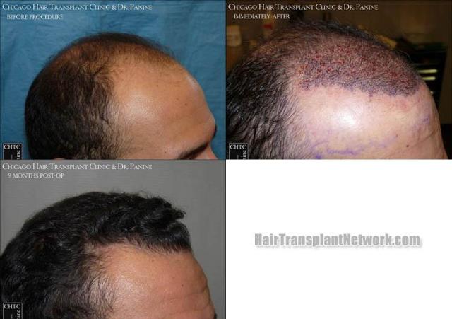 Hair transplantation surgery before and after images