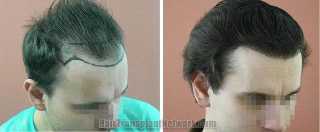 Hair restoration procedure before and after pictures