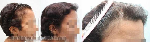 Hair transplantation surgery before and after images