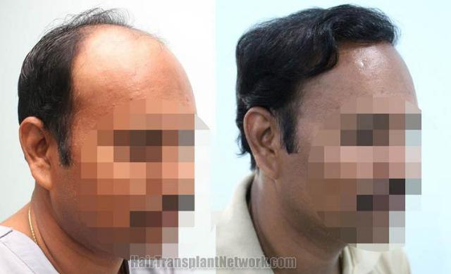 Hair restoration procedure before and after results