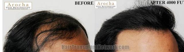 Hair transplantation surgery before and after images