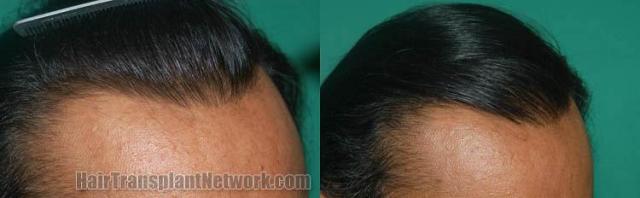 Hair restoration procedure before and after results