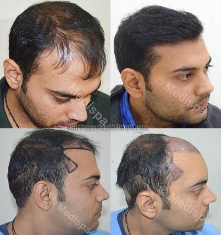 Hair transplantation surgery before and after images