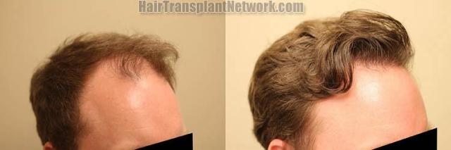 Hair transplantation surgery before and after images