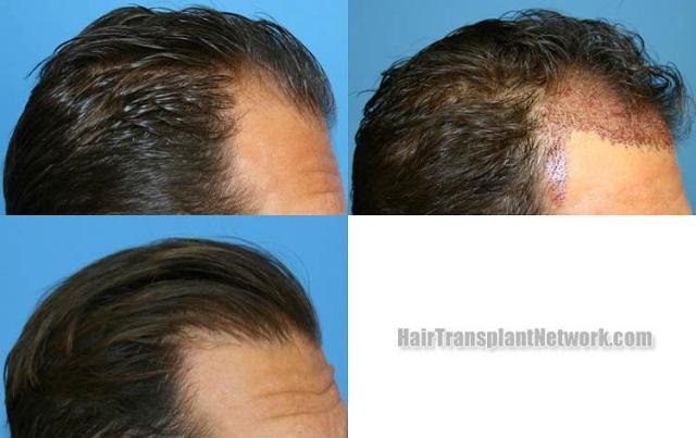 Hair restoration procedure before and after results