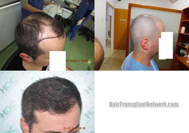 Hair restoration procedure results