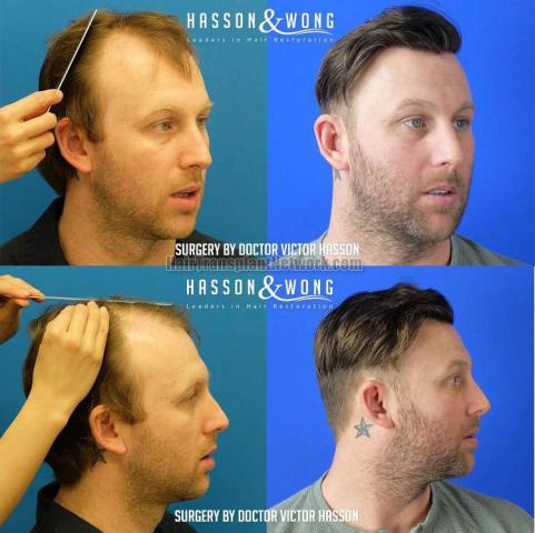 Hair transplantation procedure before and after results