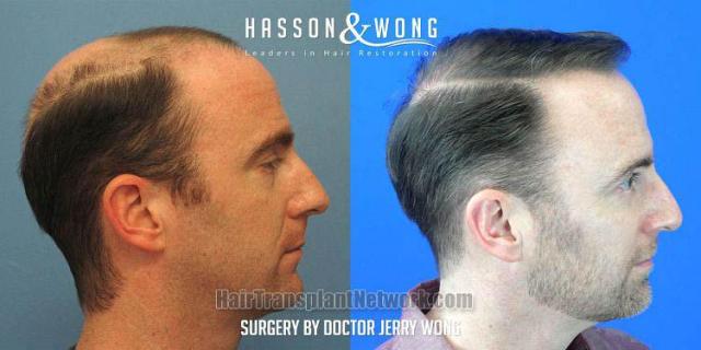 Hair transplantation procedure before and after results