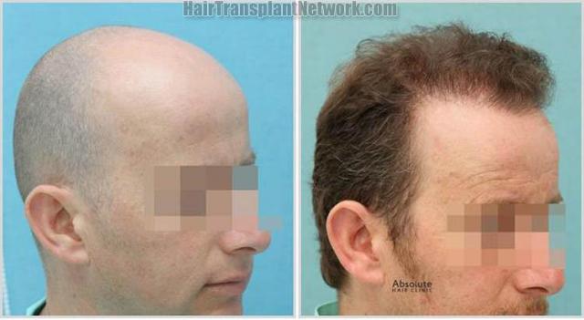 Hair restoration procedure before and after results