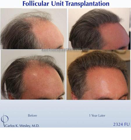 Hair transplantation procedure before and after results