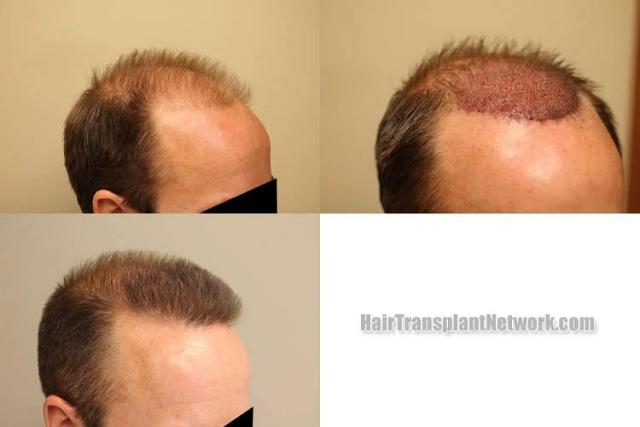 Hair transplantation procedure before and after results