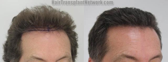 Hair restoration procedure after result images