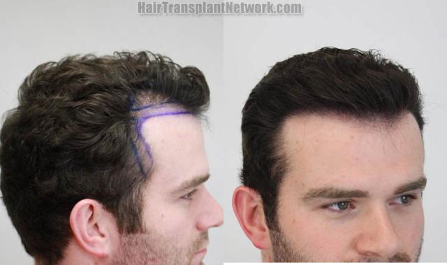 Hair transplantation procedure before and after results