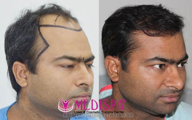 Hair restoration procedure before and after results