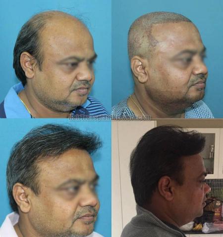 Hair transplantation procedure before and after results