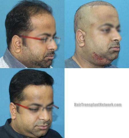 Hair transplantation procedure before and after results