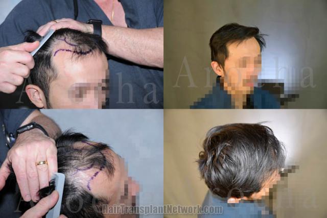 Hair transplantation procedure before and after results