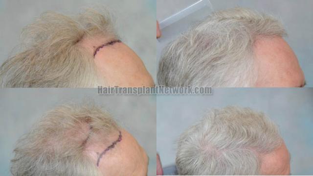 Hair transplantation procedure before and after results