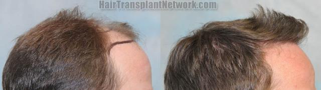 Hair transplantation procedure before and after results