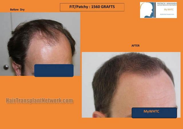 Hair transplantation surgery before and after photos