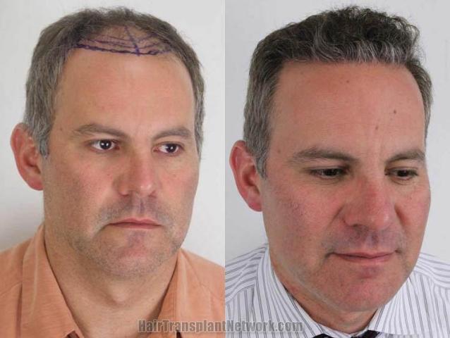 Hair transplantation surgery before and after images