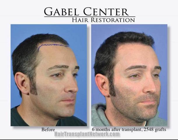 Hair transplantation surgery before and after images