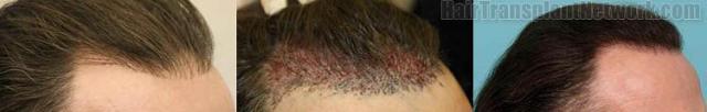 Right view before and after hair replacement procedure